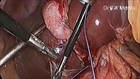 Laparoscopic Cholecystectomy by Dr. R.K. Mishra at World Laparoscopy Hospital